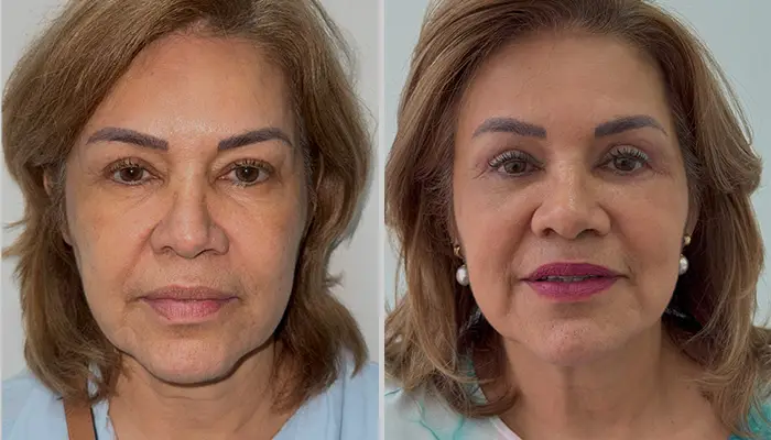 Blefaroplastia