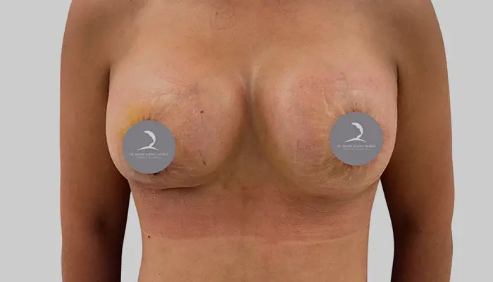 Mamoplastia