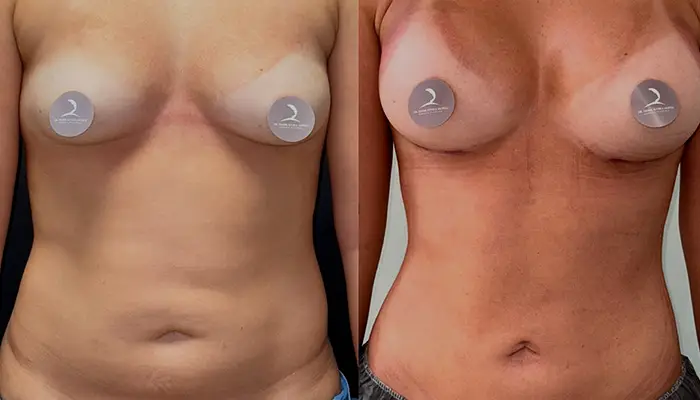 Mamoplastia + Liposucción