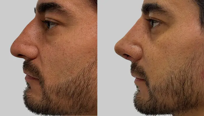 Rinoplastia